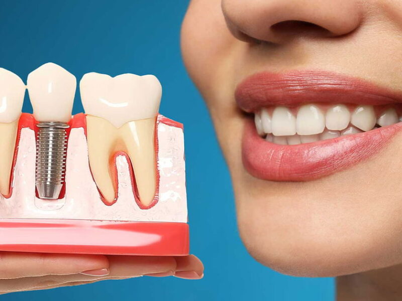 Zirkonyum İmplant Nasıl Yapılır?