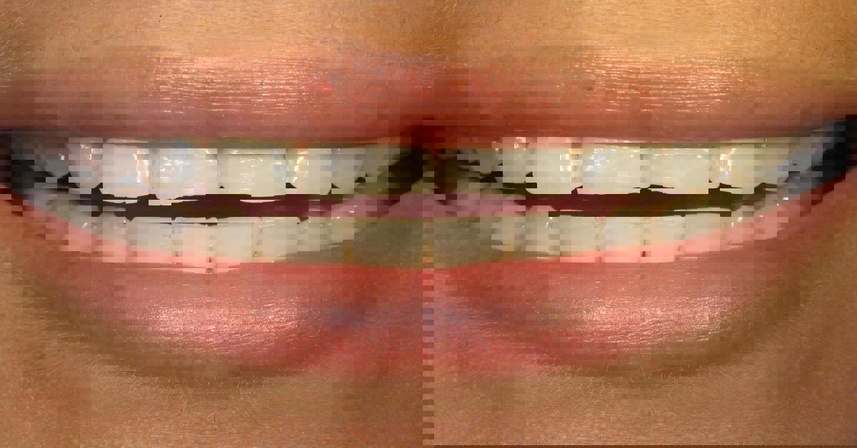 Diş Aşınması Nedir?