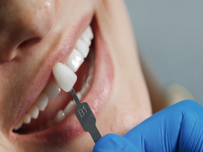 Kron Kaplama Nasıl Yapılır?